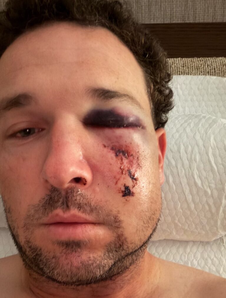 Alex Bregman sufre múltiples fracturas en el rostro, pero no necesitará cirugía